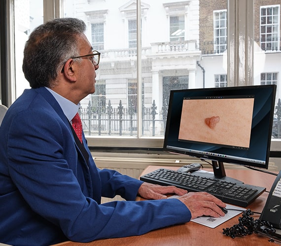 warts consultation