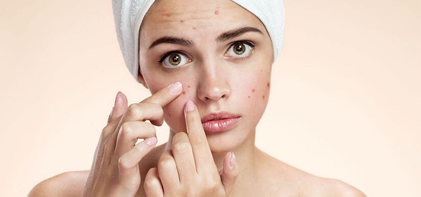 Acne Treatment Clinic in London