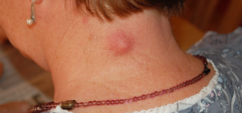 Sebaceous Cyst Removal and Treatment Clinic