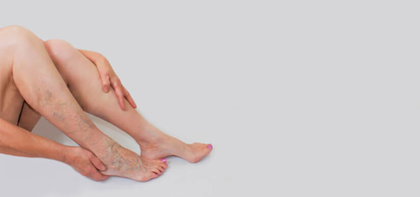 Thread Vein Removal Clinic
