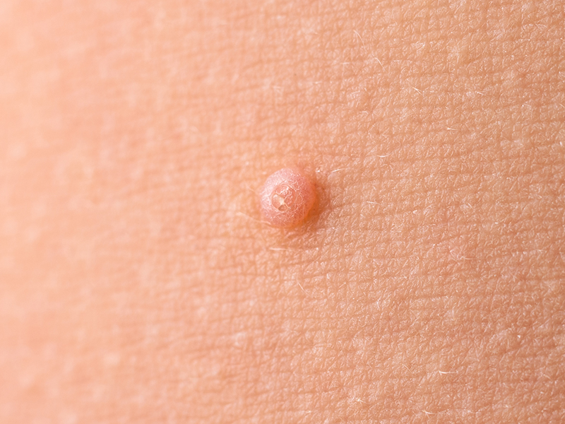 Viral warts
