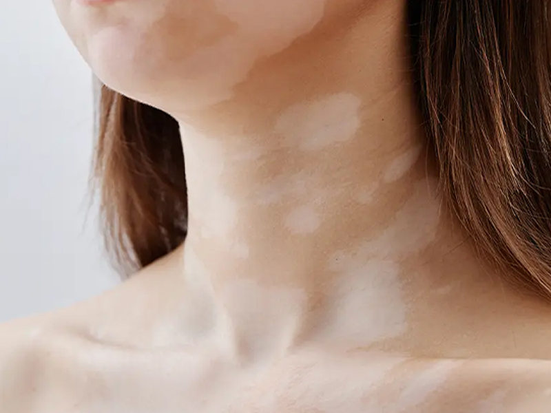 vitiligo clinic